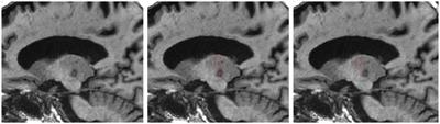 Tremor suppression following treatment with MRgFUS: skull density ratio consistency and degree of posterior dentatorubrothalamic tract lesioning predicts long-term clinical outcomes in essential tremor